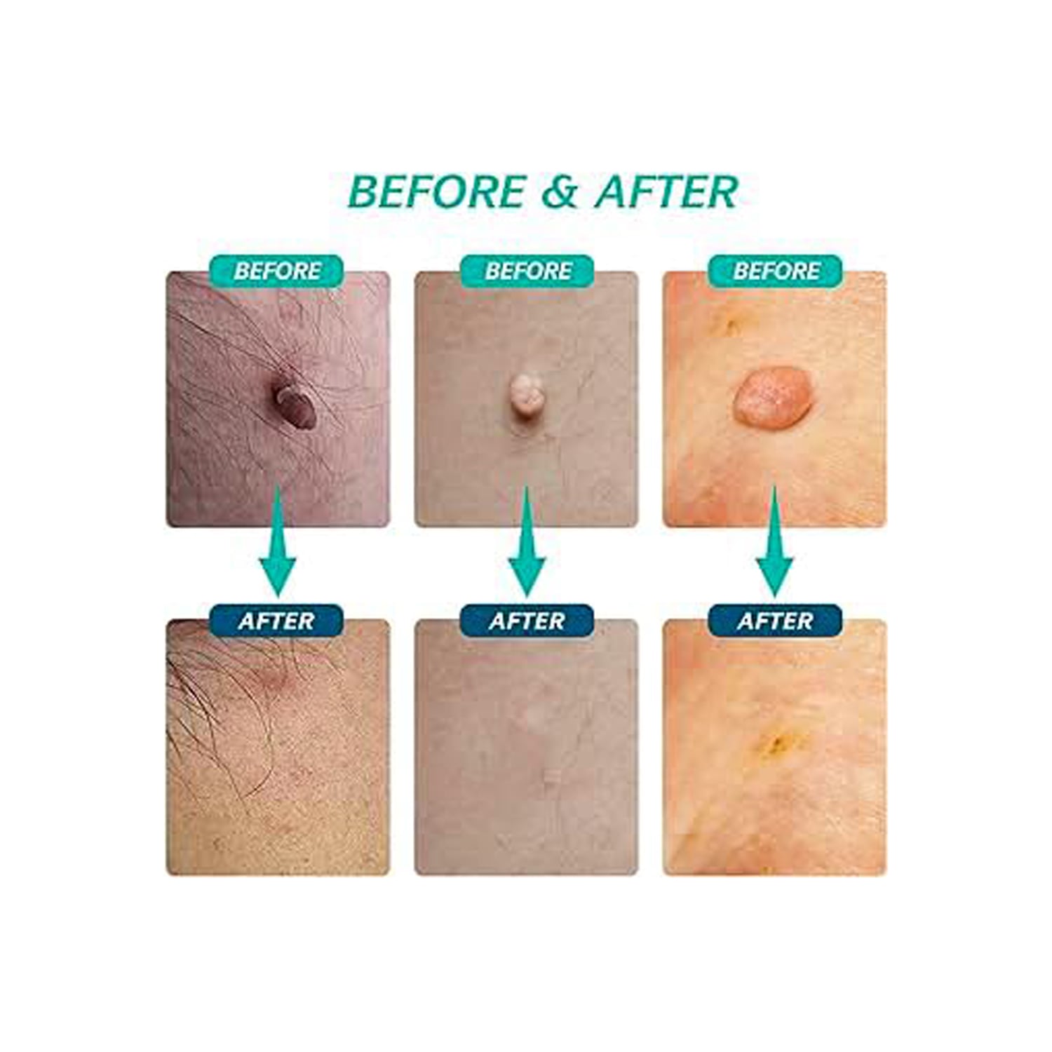 Ayurvedic D-Wart Cream | Herbal Wart & Skin Tag Remover | For Clear & Healthy Skin - 10g - Image 2